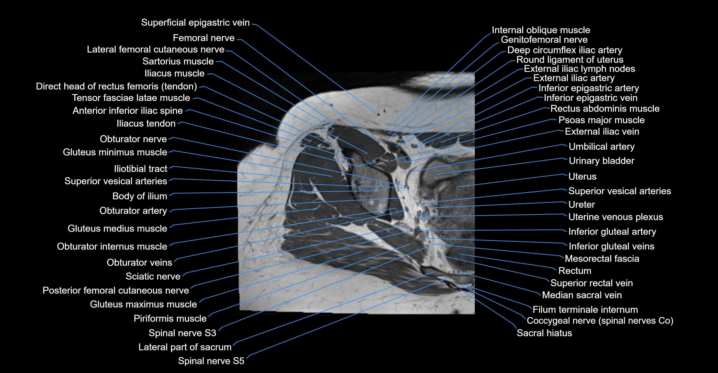 MRI hip axial cross sectional anatomy 3T 3D  radiology  anatomy image-img-00001-00022.webp